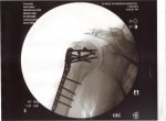 12-1-2012 8;16;00 AM Tonys suregery.jpg