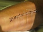 mickeys scar2.jpg